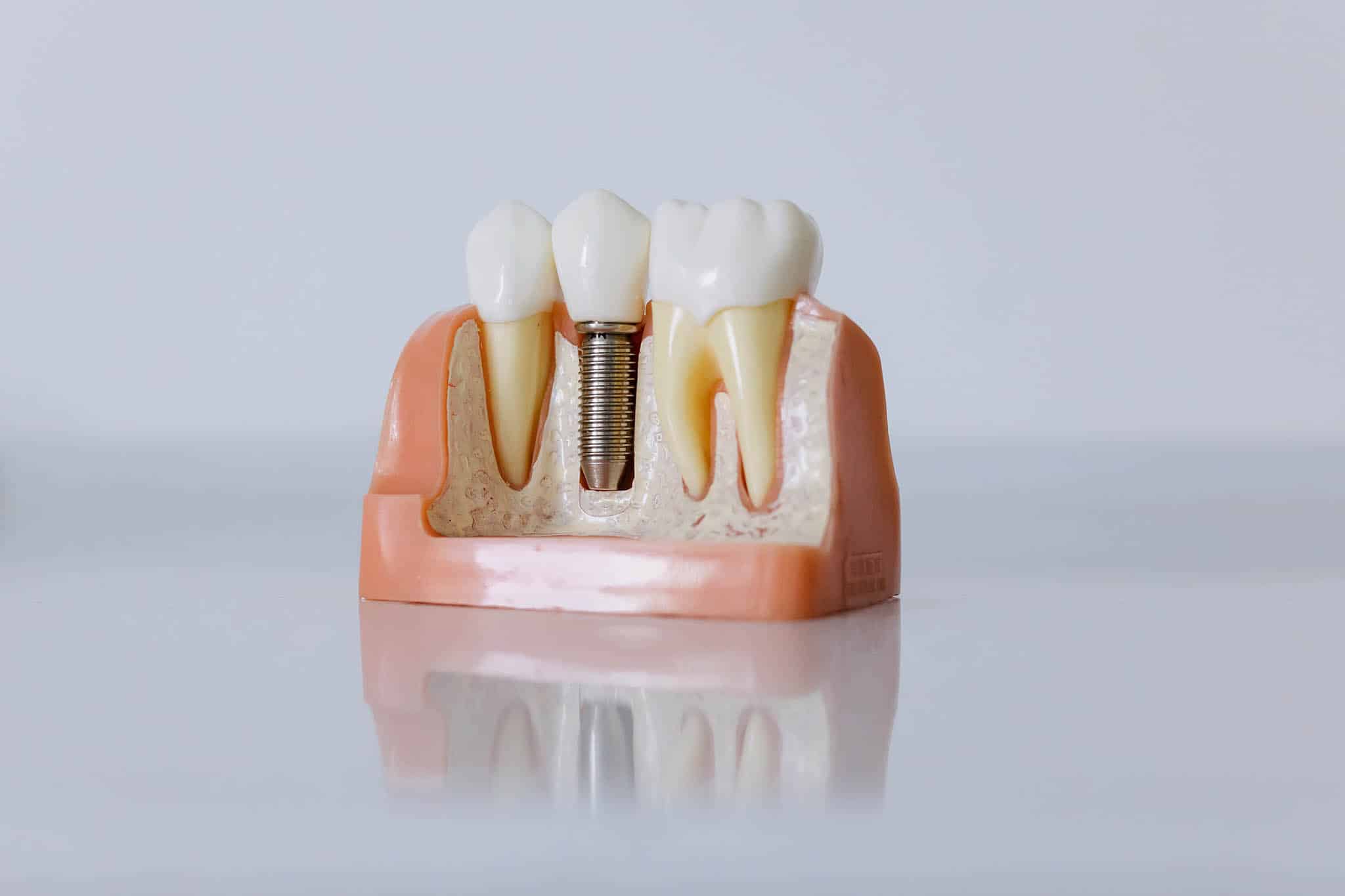 comparar seguros dentários para implantes